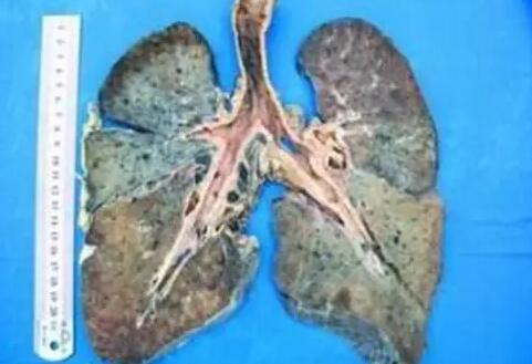 煙塵肺病——焊接香蕉黄色电影